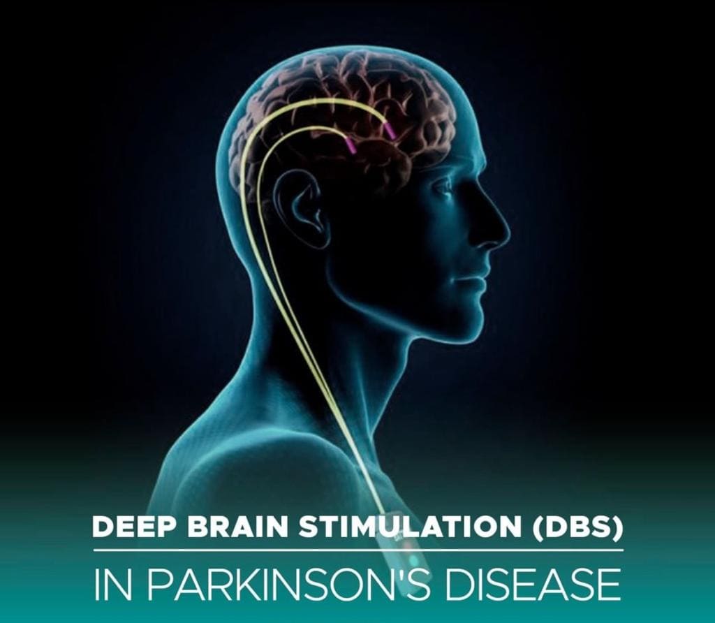 Deep Brain Stimulation for Parkinson's